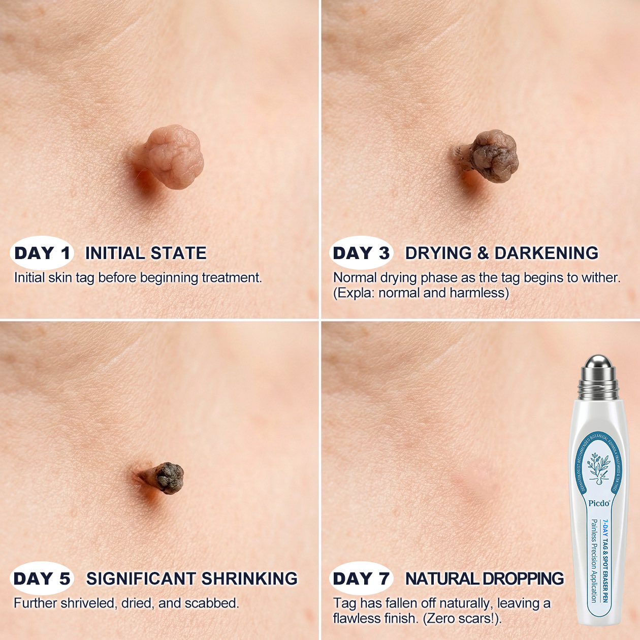 𝐏i𝐜𝐝o®💎7-𝐷𝑎𝑦 𝗧𝐚𝐠 & 𝗦𝗽𝐨𝐭 𝐄𝐫𝒂𝒔𝒆𝒓(Zero Pain, Zero 𝐒𝐜𝐚𝒓𝒔 Rollerball)