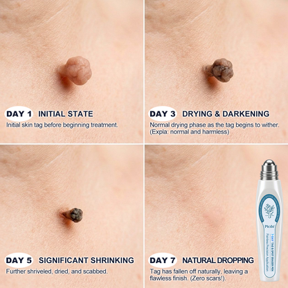 𝐏i𝐜𝐝o®💎7-𝐷𝑎𝑦 𝗧𝐚𝐠 & 𝗦𝗽𝐨𝐭 𝐄𝐫𝒂𝒔𝒆𝒓(Zero Pain, Zero 𝐒𝐜𝐚𝒓𝒔 Rollerball)